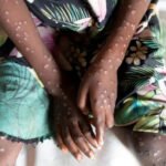 La OMS declara una emergencia sanitaria internacional por brote de mpox (antes viruela del mono)